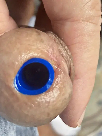 1. 5 cm hollow plug after cut