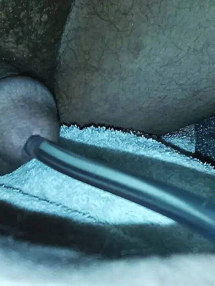 Stalemate Pressure Equalized Peehole Bladder