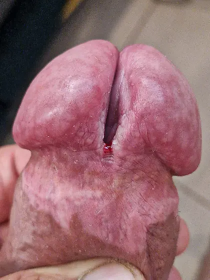 the slit of my glans is getting bigger