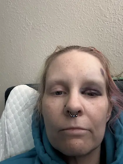 Fell and ended up with a black eye - ain’t it ni