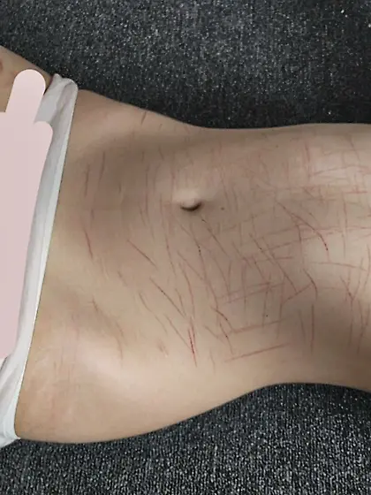 【R's Breast Cuttings Healed】