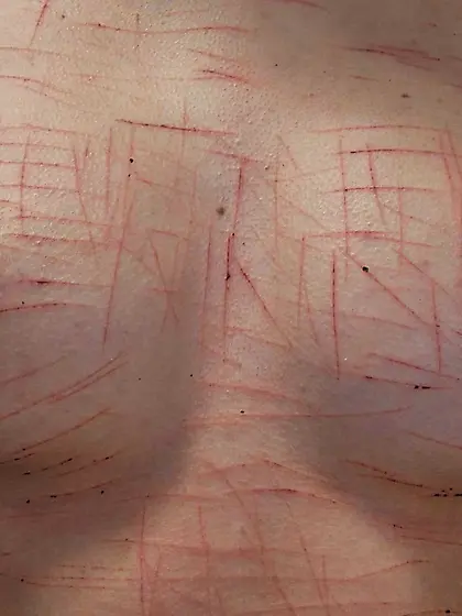 【R's Breast Cuttings Healed】