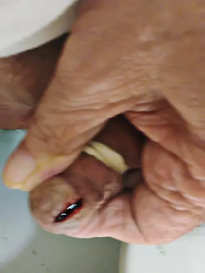 Penectomy Penis