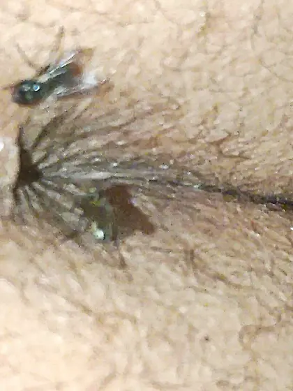 Flies on my anus in the village.  06. 2025