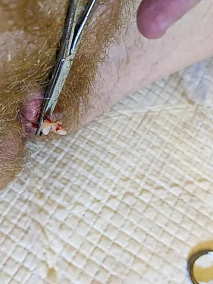 Clit hood trimming