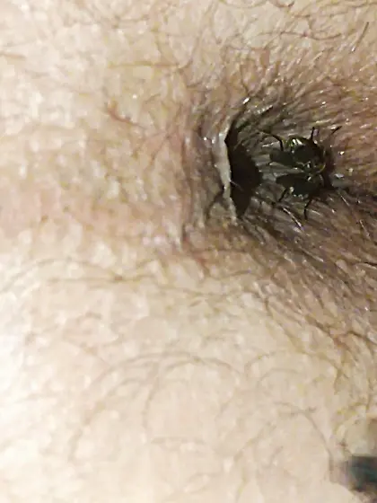 Flies on my anus in the village.  06. 2025