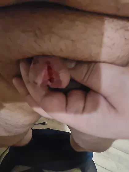 Beginning to split my Glands